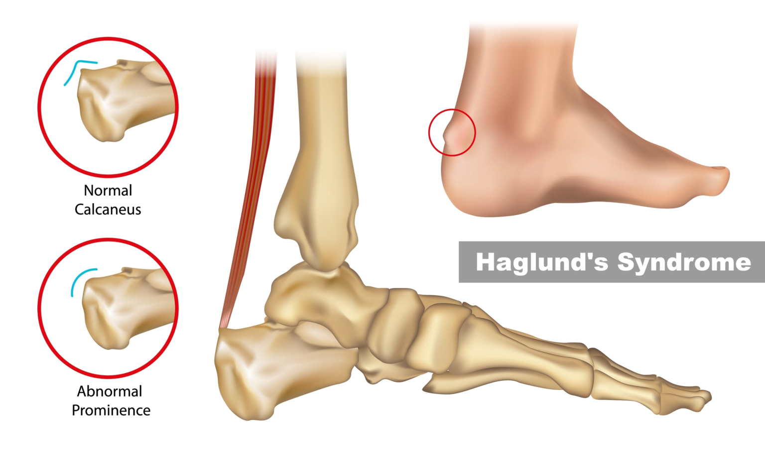 Haglunds Deformity Frisco Foot And Ankle Specialists 2601